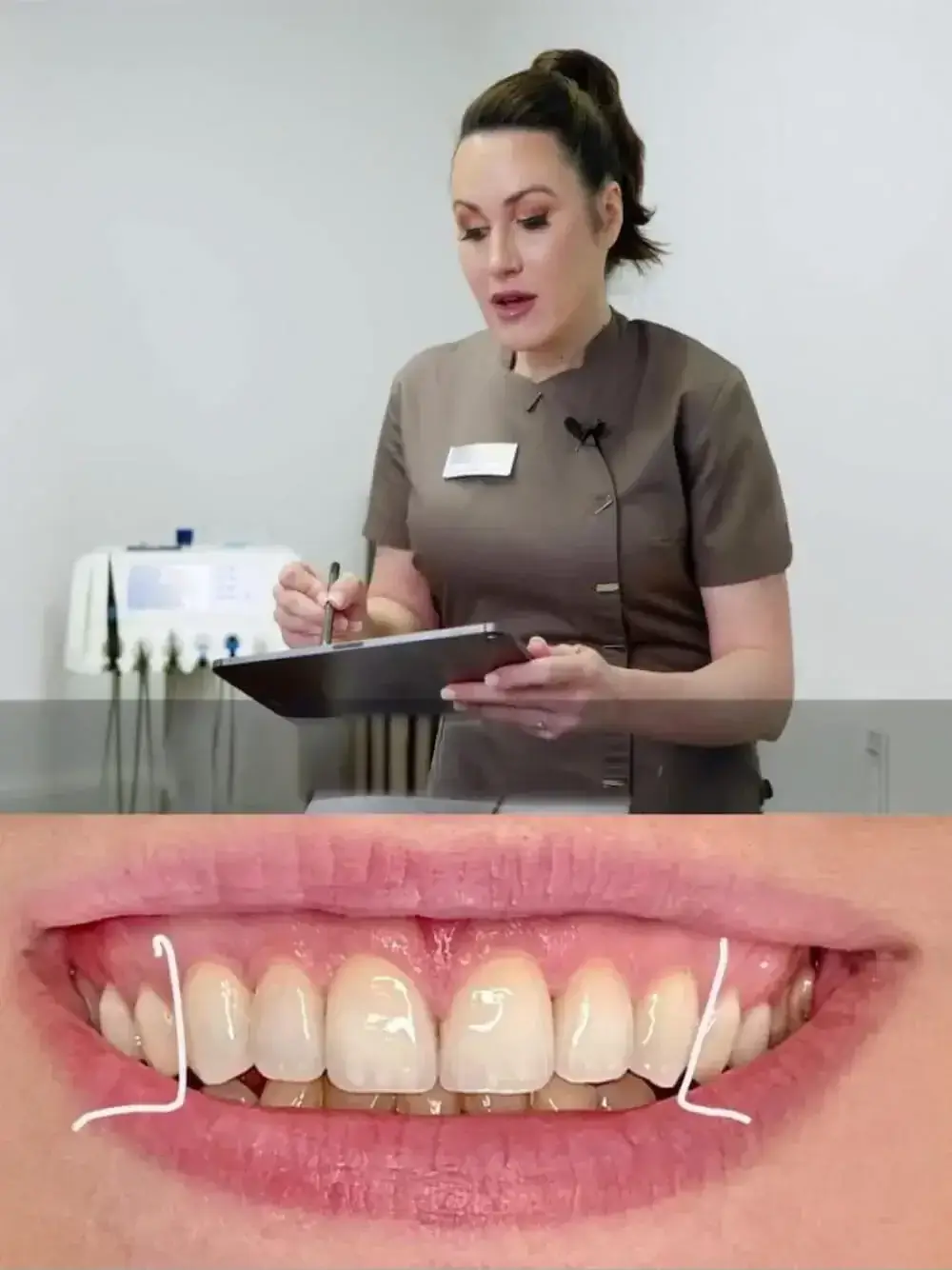 veneers