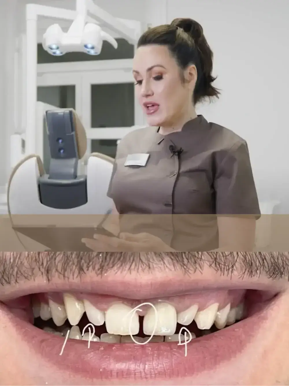 Veneers